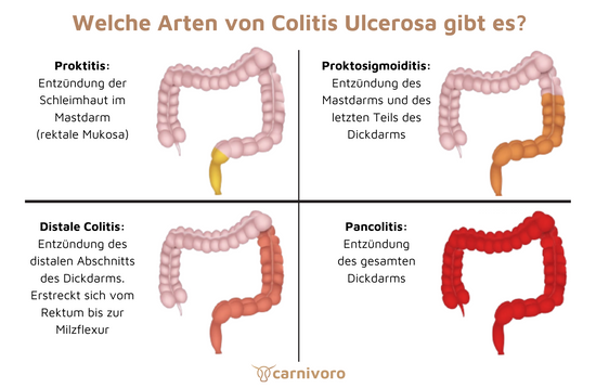 Colitis Ulcerosa carnivoro